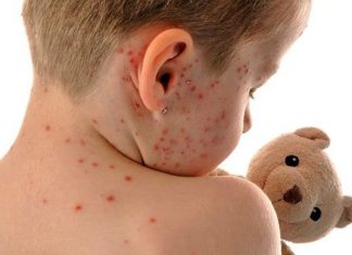 Roberto Debbag: “Hay que estar atentos y preocupados por el sarampión”