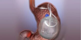 Monte Grande: presentan un novedoso método de balón gástrico