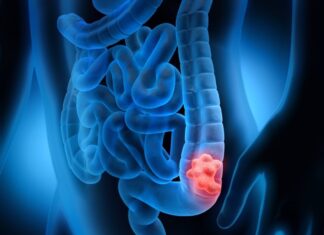 Advierten que el consumo indiscriminado de antibióticos aumenta las probabilidades de contraer cáncer de colon