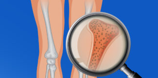 Día Internacional de la Osteoporosis