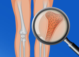 Día Internacional de la Osteoporosis